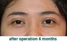 plastic-surgery-blepharoplasty